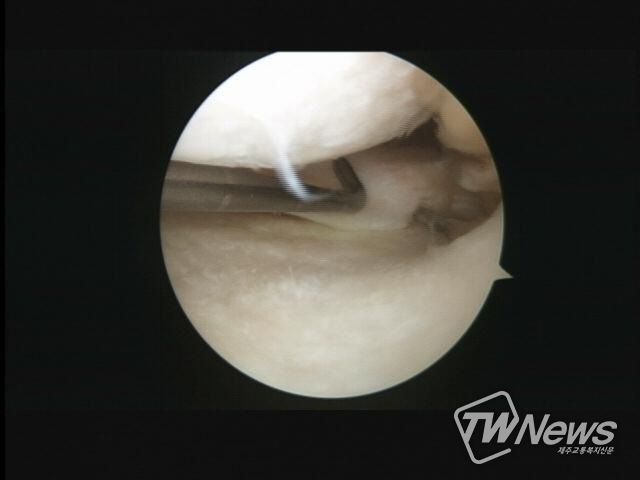 내측 반월상 연골판 파열