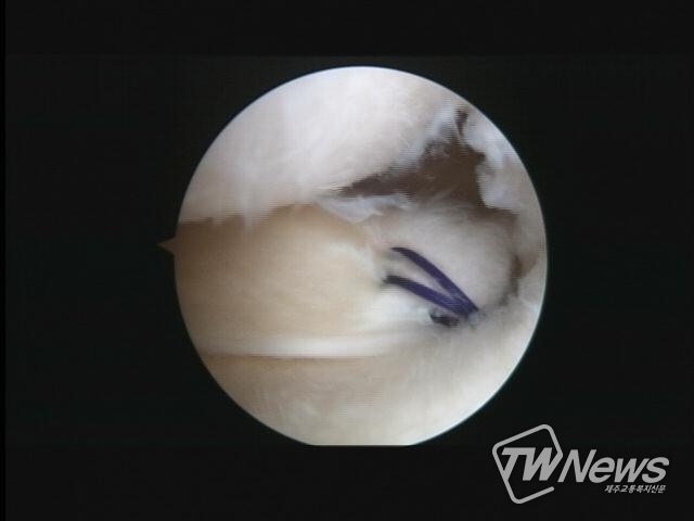 봉합술 후의 모습